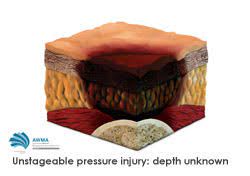 <p>Unstageable Pressure Injury</p>
