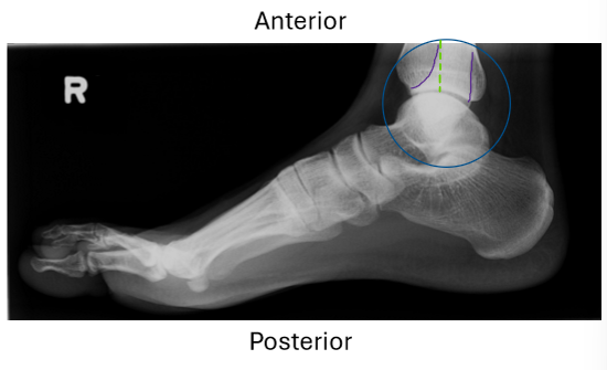 <p>MAIN: talar domes are aligned ant/post</p><ul><li><p>distal fib SI on post. half of tib</p></li><li><p>MT heads SI</p></li></ul><p></p><p>INT.ROT:</p><ul><li><p>ant. fib</p></li></ul><p>EXT.ROT:</p><ul><li><p>post. fib</p></li></ul><p></p>