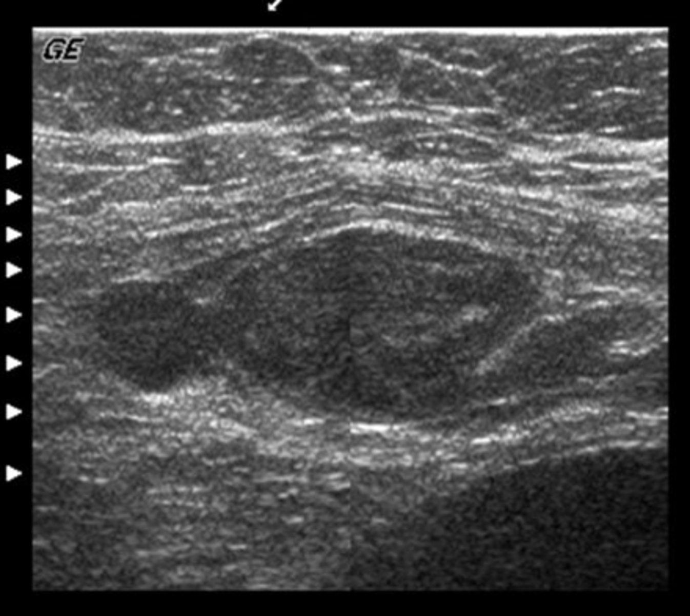 <p>You have obtained this image from the mid abdomen of a patient with a history of severe sneezing and a palpable abdominal mass. What pathology is present in this image?</p><p>a. rectus sheath hematoma</p><p>b. aortic aneurysm</p><p>c. lymphadenopathy</p><p>d. bowel tumor</p><p>e. abdominal hernia</p>