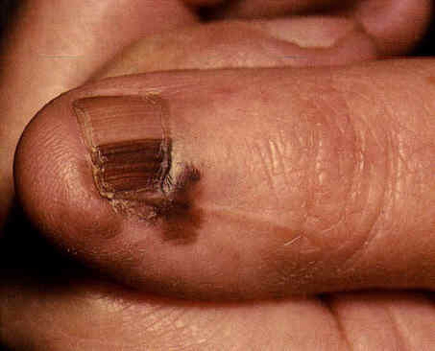 <p>-most commonly found on LE (78%)</p><p>-black, variegated brown, multicolored, irregularly shaped papule, macule, patch</p><p>-nail apparatus: Hutchinson's sign</p>