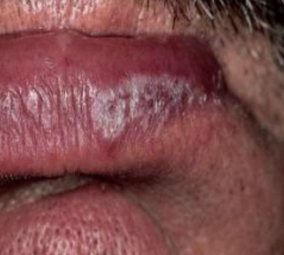 <p>lesion on vermillion zone, associated with autoimmune condition with butterfly rash </p>