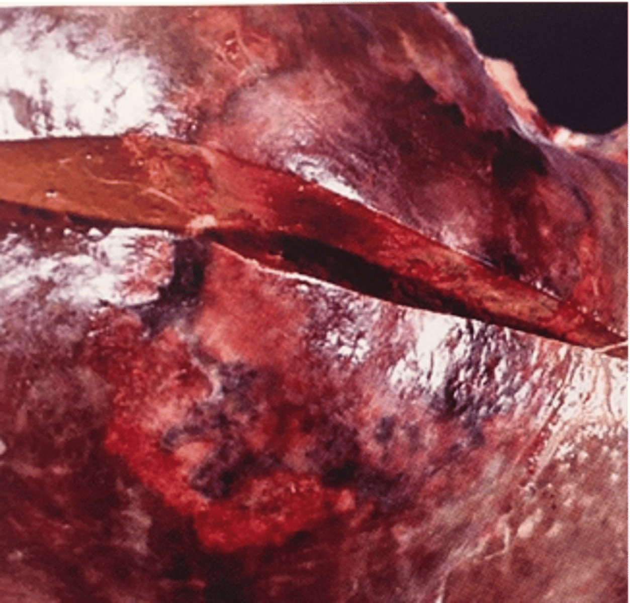 <p>the pathology of this liver indicates what disease</p>