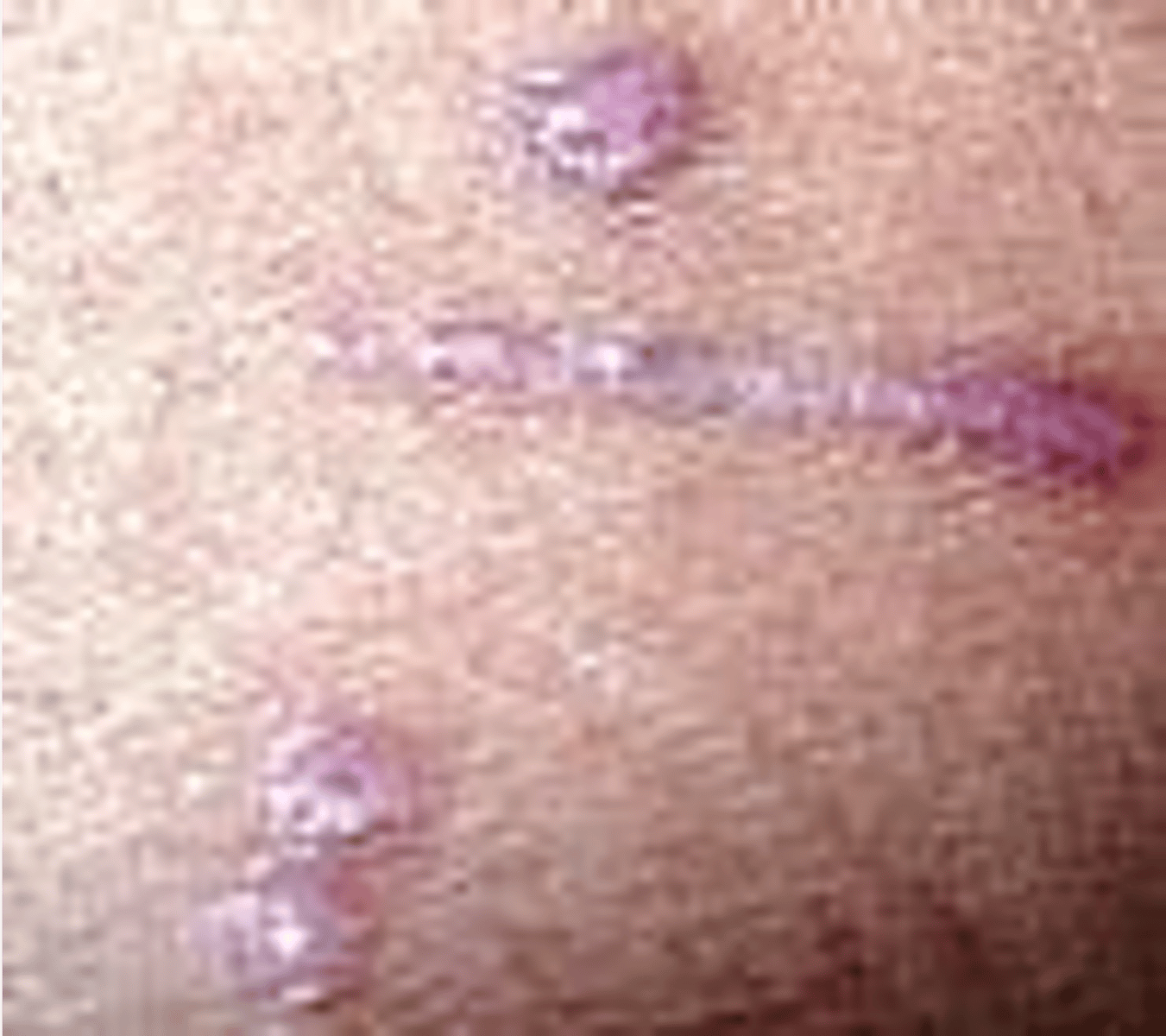 <p>______________:</p><p>•Develops in adulthood</p><p>•Women &gt; men</p><p>• Etiology: mostly unknown</p>