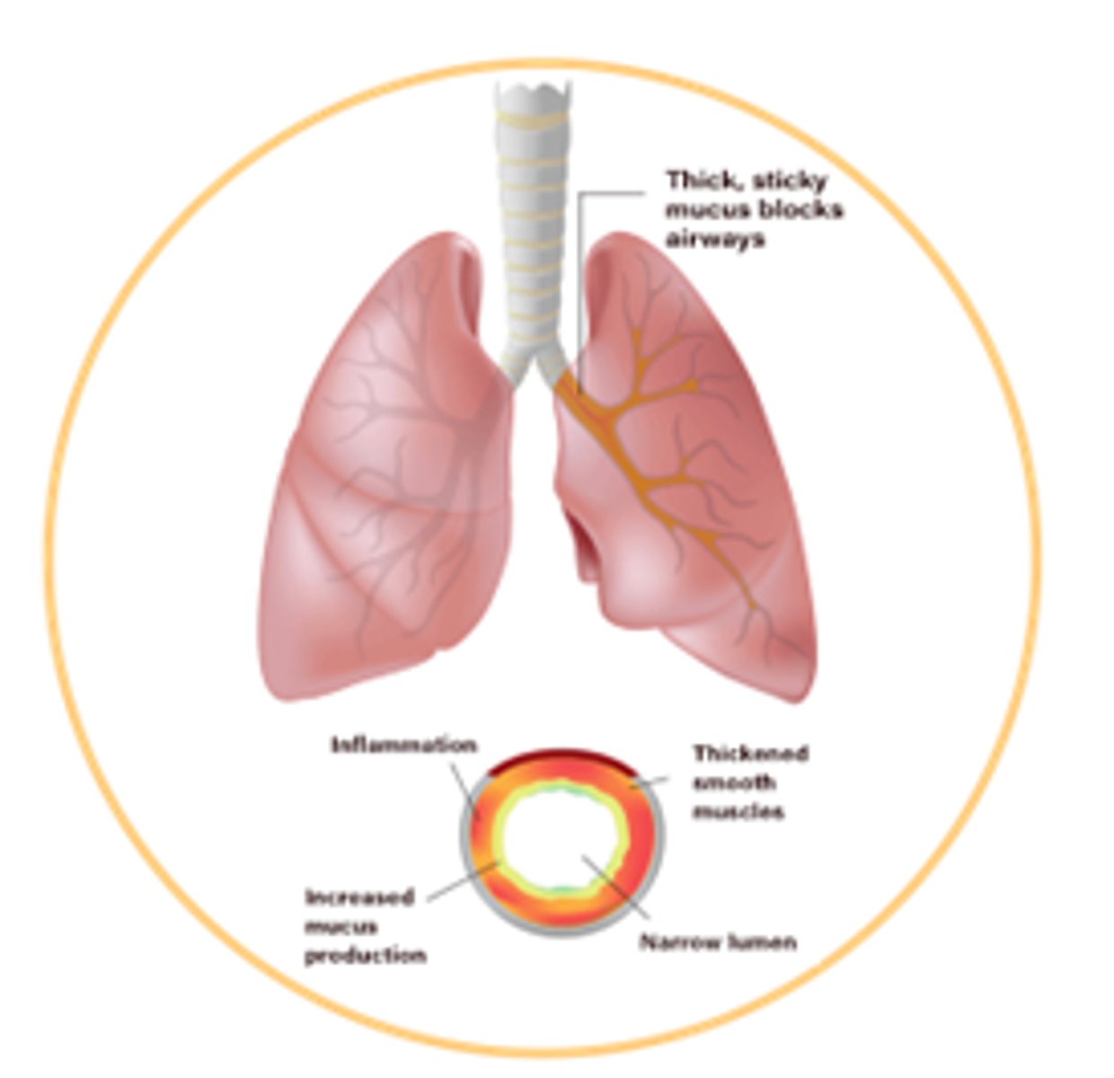 <p>- Mucus plugging and structural changes.</p><p>- Massive neutrophil infiltration in airways.</p><p>- Inflammatory damage to airway tissue.</p><p>- Decline in lung function.</p><p>- Epithelial damage.</p>