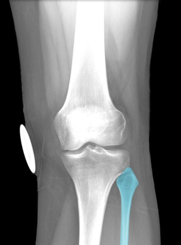 Description:
Long, thin bone
Articulates with tibia (proximal) and
talus (distal)
Characteristic features include head,
neck, shaft, and lateral malleolus