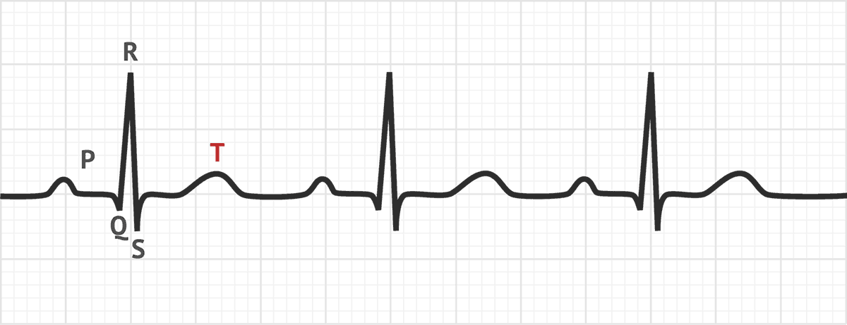 <p><span>The T wave on an ECG represents ventricular repolarization.</span></p><p><span>True or False</span></p>