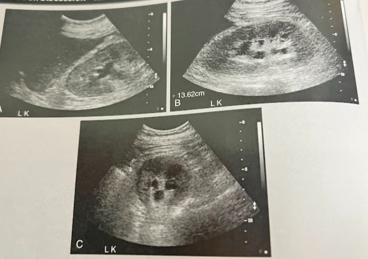 <p>A 45 year old woman presents to the ED w/severe back pain. The requisition states “abnormal renal function - r/o obstruction.” What clinical findings indicate an acute rather than chronic condition. Are these findings consistent w/an obstructive cause of renal impairment? What do the fluid filled structures in the kidney likely represent? Are they related to renal function? </p>