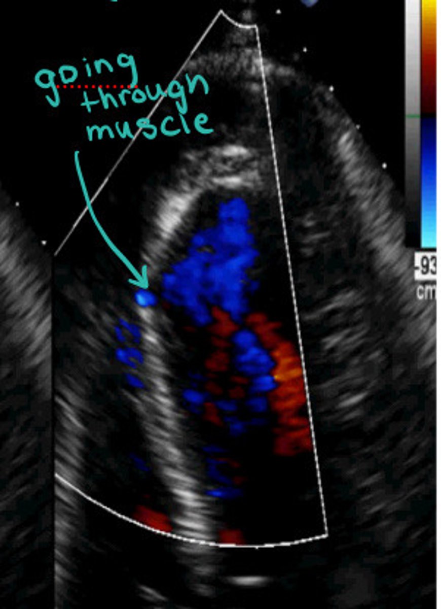 <p>What does this flow through the IVS indicate</p>