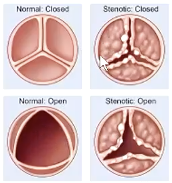 <p>aortic or pulmonic stenosis</p>