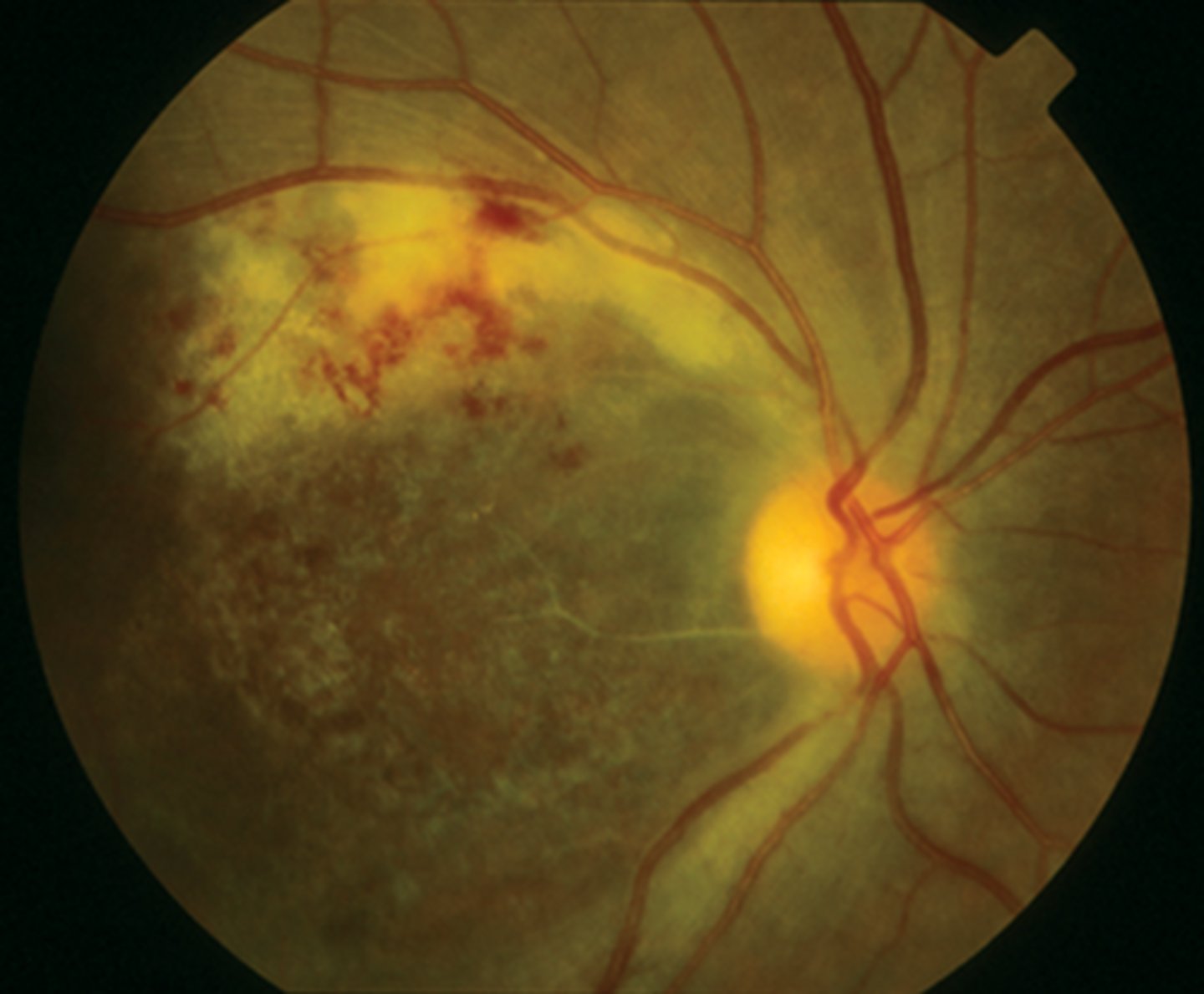 <p><u>Etio</u>: <strong>CMV </strong>that causes death of cells in the retina, CMV occurs when immune system is down</p><p><u>Risk factors</u>: pt with transplants or is immunocompromised</p><p><u>S&amp;S</u>: <strong>yellow-white patches</strong></p><p><u>Testing</u>: CD4 &lt; 50 mcL</p><p><u>Referral</u>: emergent consult ophthalmologist and infectious disease</p>