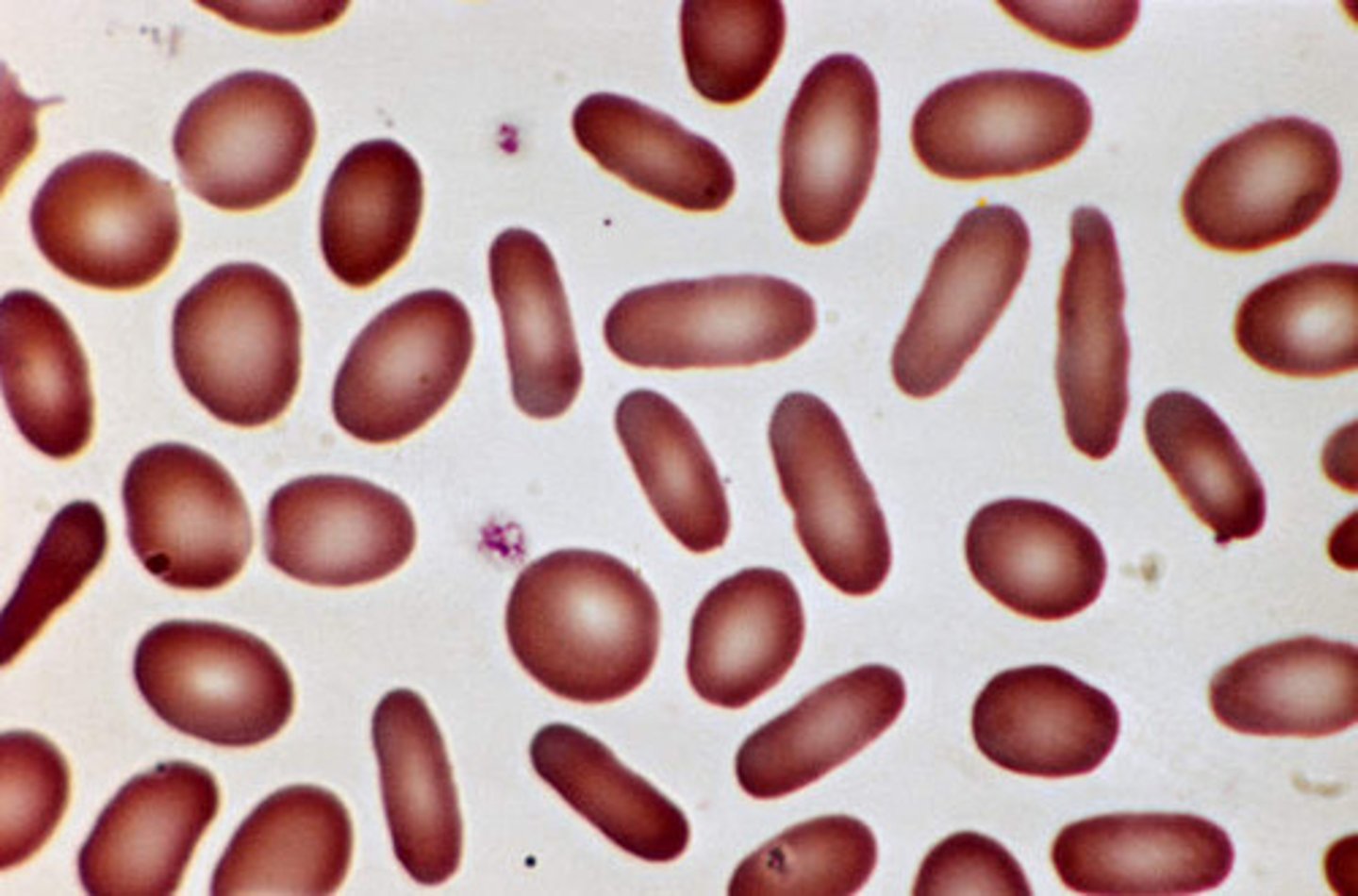 <p><strong><mark data-color="yellow" style="background-color: yellow; color: inherit;">Hereditary elliptocytosis, iron deficiency anemi</mark>a</strong>, thalassemia, anemia of chronic disease</p>