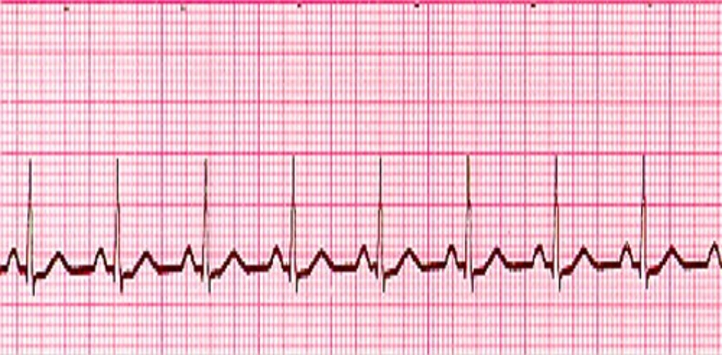 <p>What does the ECG show?</p>