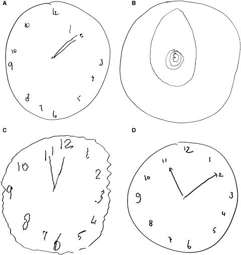 <p>Can detect difficulties with visuospatial skills, visual perception, selective attention, memory, abstract thinking, and executive functioning</p>
