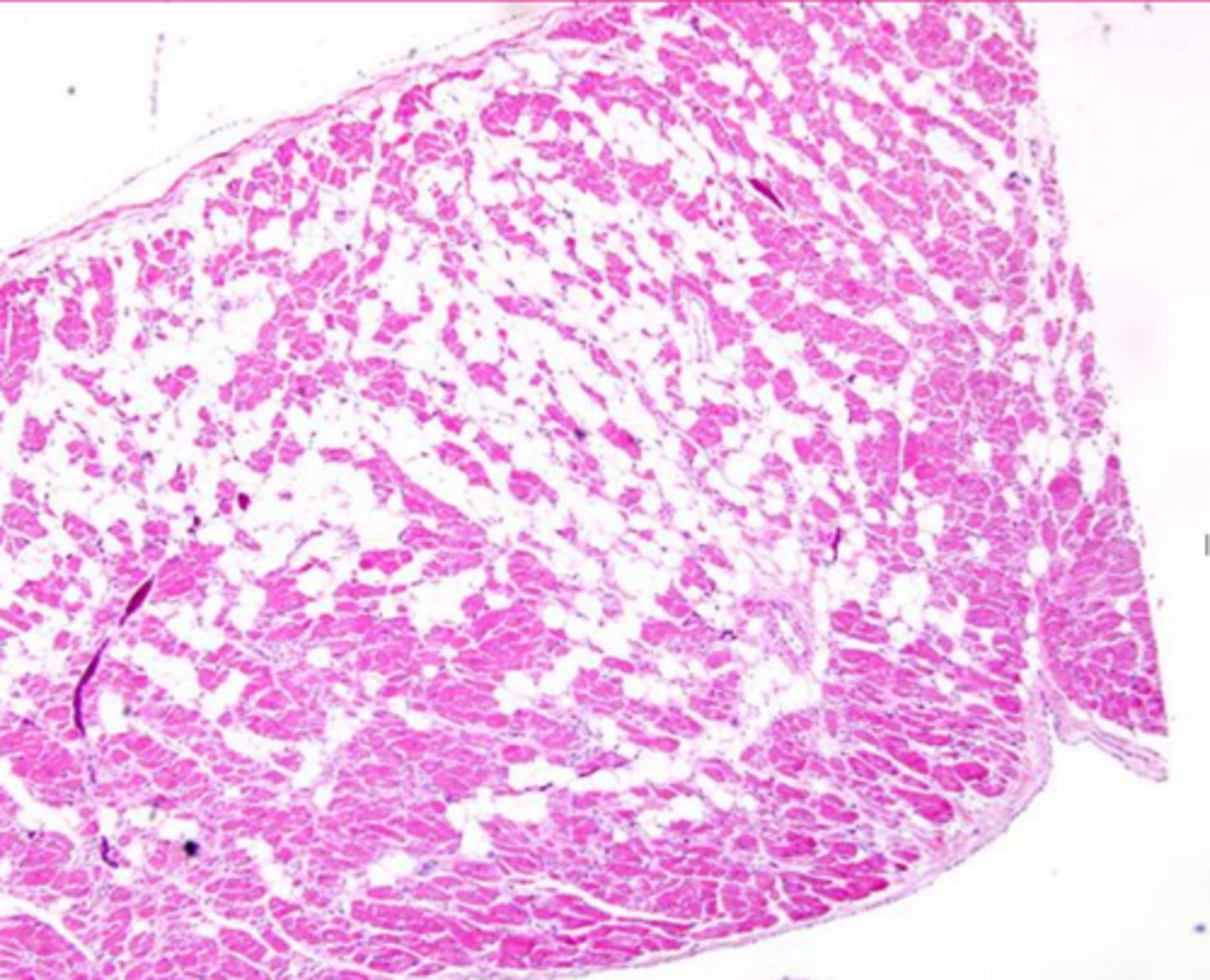 <p>Describe the extracellular accumulation (this is a heart muscle)</p>