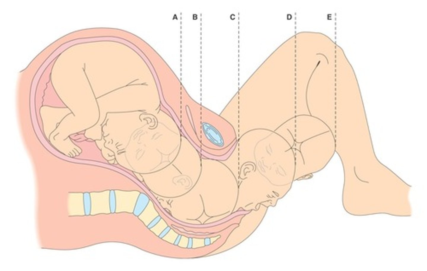 <p>Fundal pressure involves applying pressure to the abdomen to assist delivery; it is contraindicated in cases of shoulder dystocia.</p>