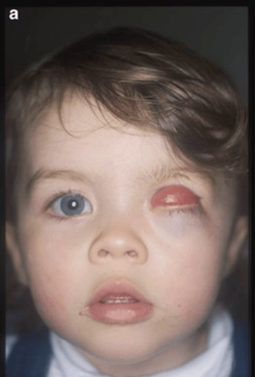<p>1. absence of entire globe</p><p>2. short conjunctival sac</p><p>3. microblepharon</p>