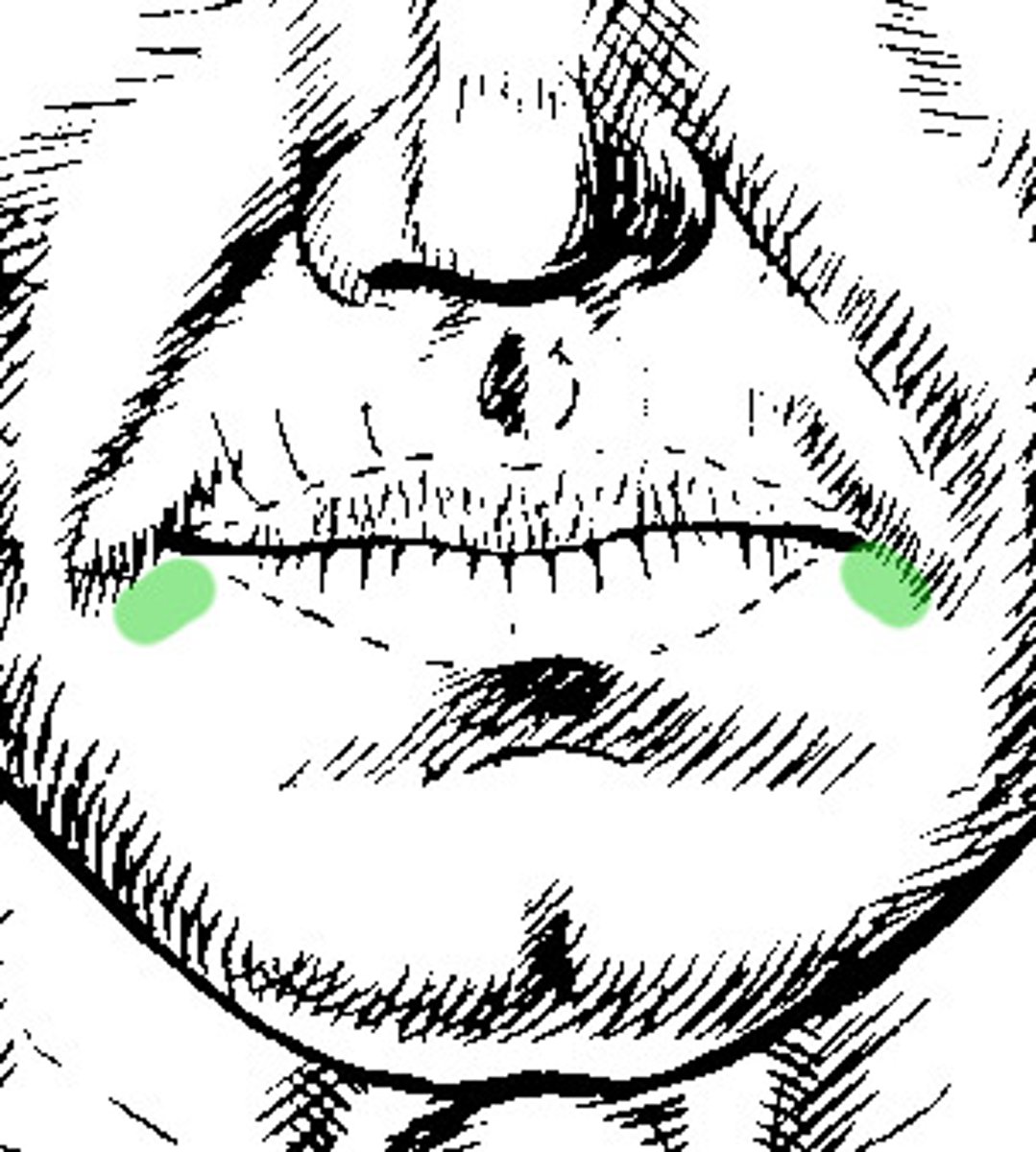 <p>furrows at the corner of the mouth</p><p>result of folding skin</p>