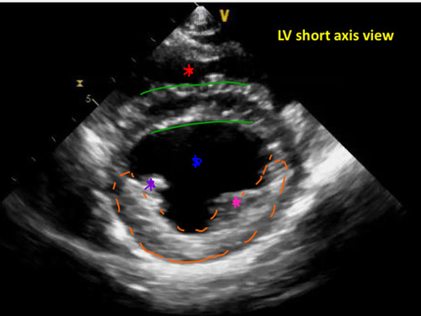 <p>ID parts of either left ventricle/right ventricle</p>