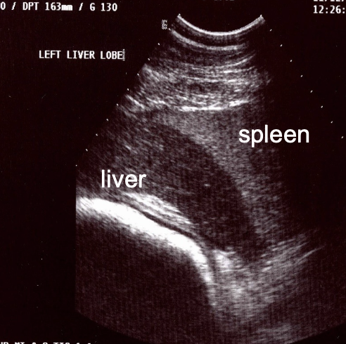 <p>-uniform</p><p>-sharp edges</p><p>-darker than spleen (left side)</p><p>-ends at or before costochondral junction (dont confuse with peritoneal fat)</p><p>-anechoic vessels visible</p><p>-no obvious biliary channels</p><p>-no shadowing structures</p>