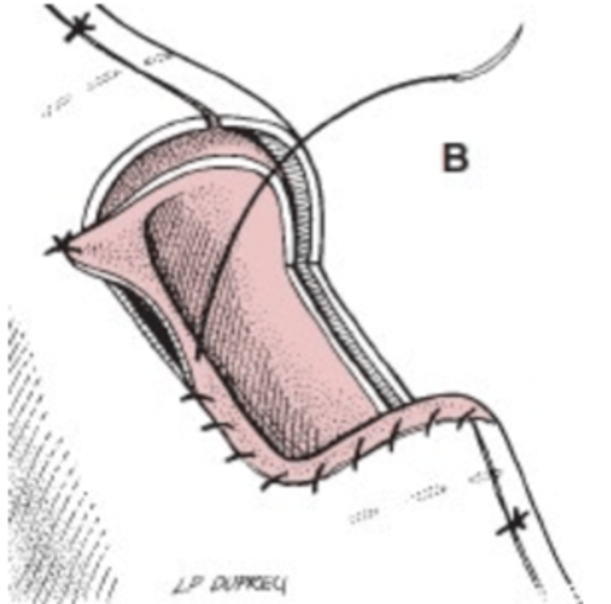 <p>subimos la traquea al piel para evitar tensión y luego suturamos la mucosa al piel</p>