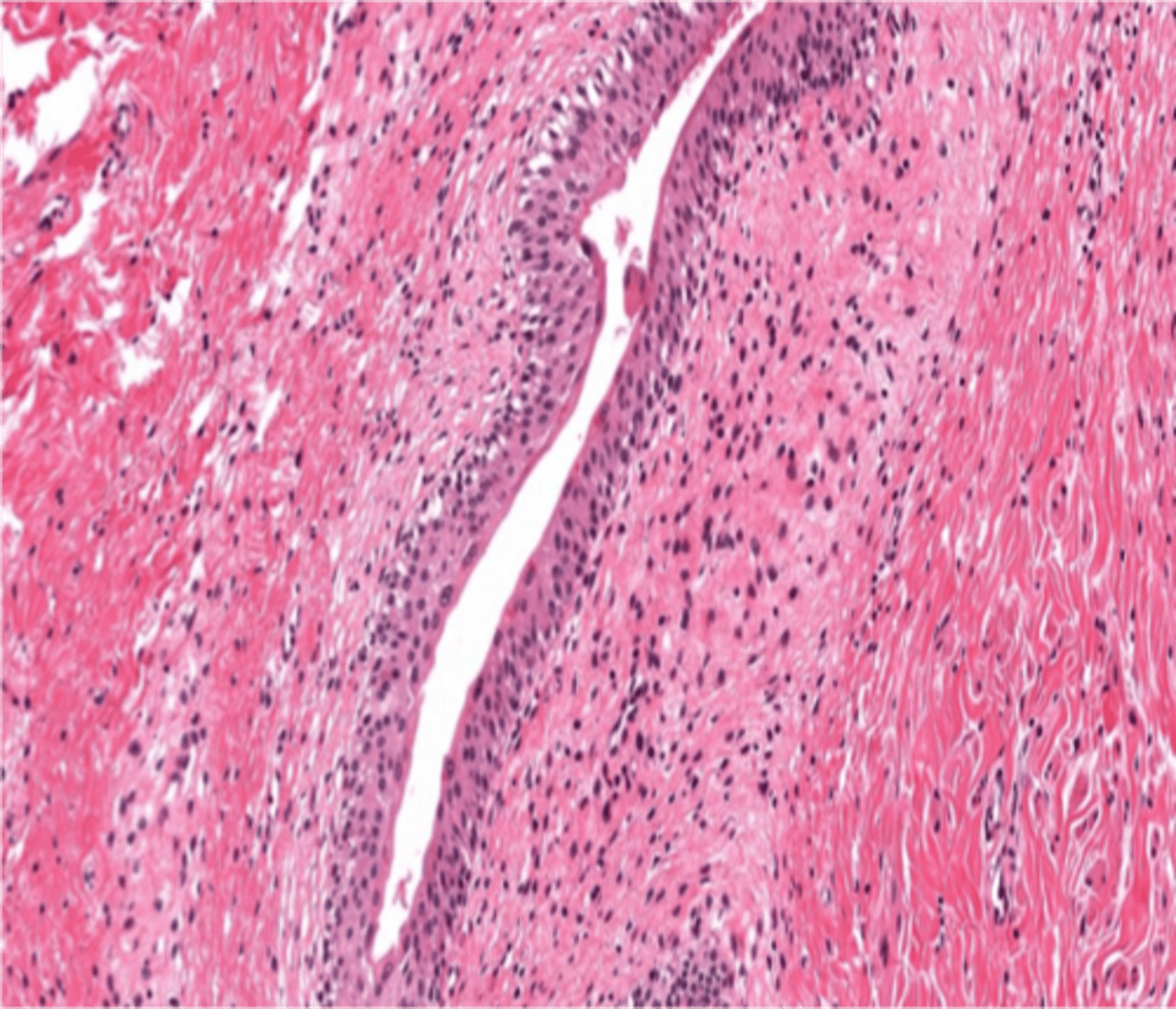 <p>(in the bladder)</p>