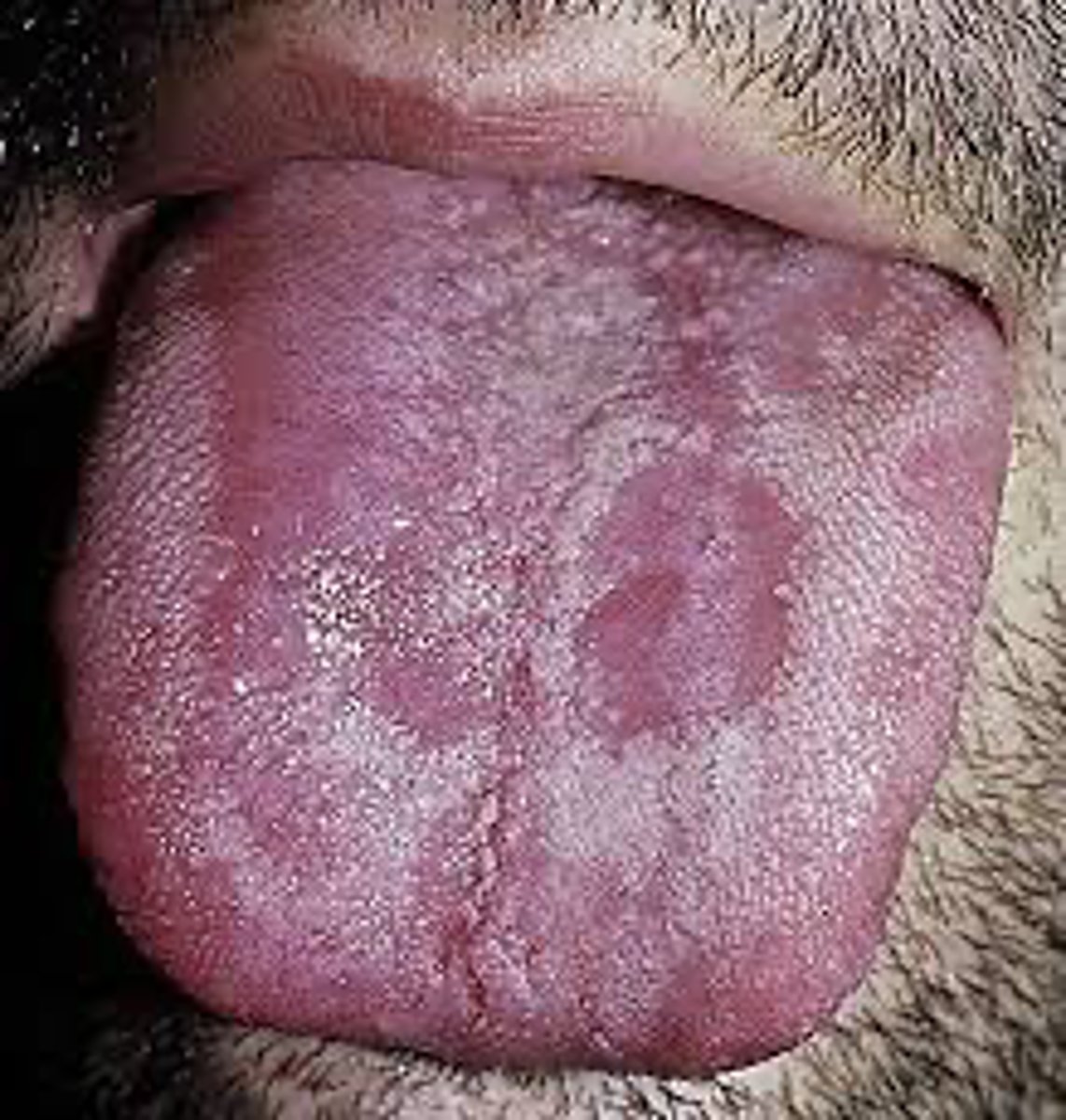 <p>A patient presents with arthritis, conjunctivitis, and urethritis. Oral lesions resember geographic tongue. What is the MOST likely diagnosis?</p>