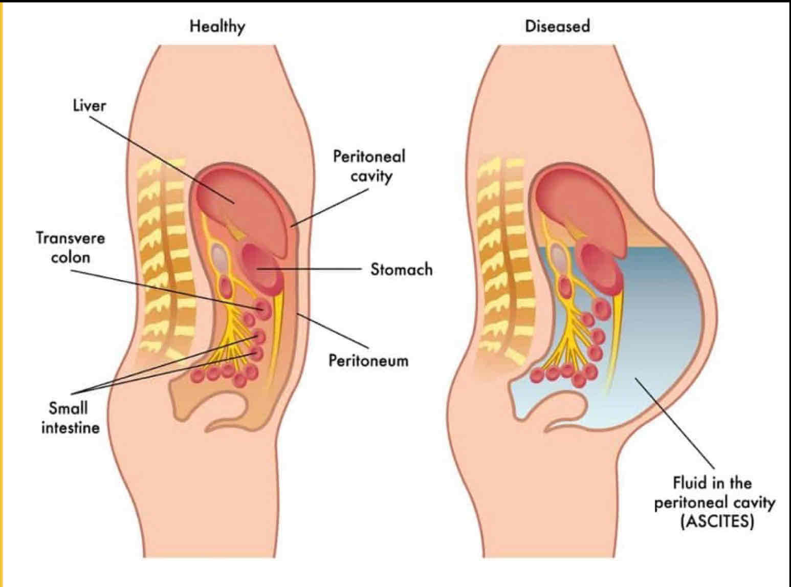 <p>The accumulation of fluid within the peritoneal cavity</p><ul><li><p>Distended abdomen</p></li></ul><p></p>