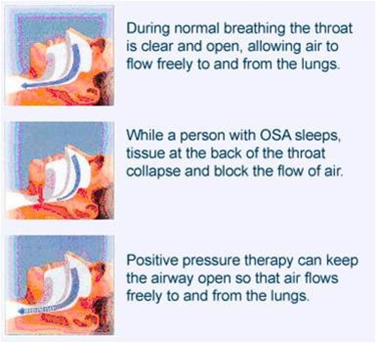 <p>soft palate airway obstruction during sleep</p><p>- apnea = no airflow</p><p>- hypoapnea = decreased airflow with desaturation</p><p>symptoms: snoring/ snorting, EDS, hypertension, morning headaches, depression, anxiety, short term memory loss</p>