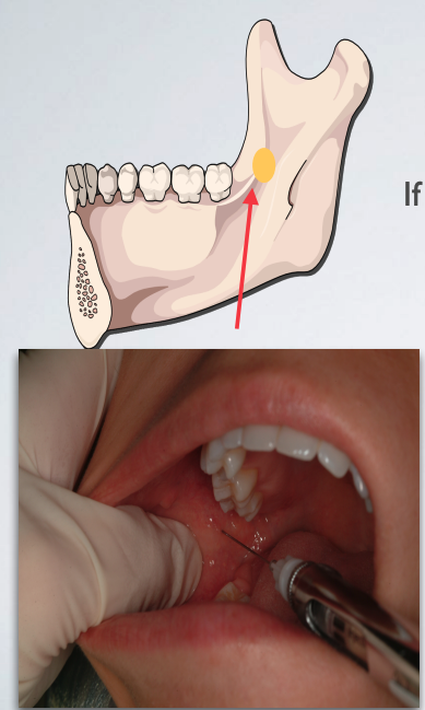 <p>Needle tip is located too anteriorly</p>