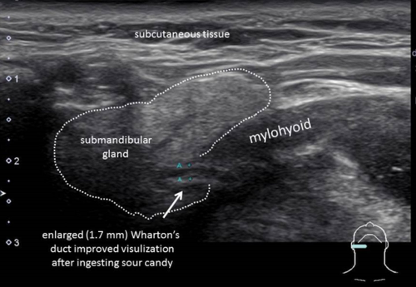 <p>-Parathyroid glands are flat, bean-shaped hypoechoic structures located posterior and medial to the thyroid lobes</p><p>-Salivary glands - homogeneous and hyperechoic compared with the normal surrounding muscle. Degree of echogenicity depends on the amount of intraglandular fatty tissue</p><p>-Carotid arteries and jugular veins appear as anechoic tubular structures demonstrating internal vascular flow </p>