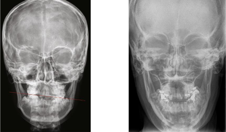 <ul><li><p>mid-facial skeleton </p></li><li><p>allows assessment of mediolateral and vertical dimensions </p></li></ul><p></p>