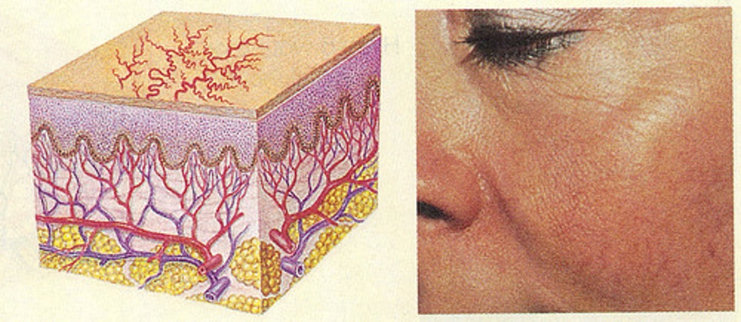 <p>Fine, irregular dilated blood vessels that blanch w/ pressure</p>