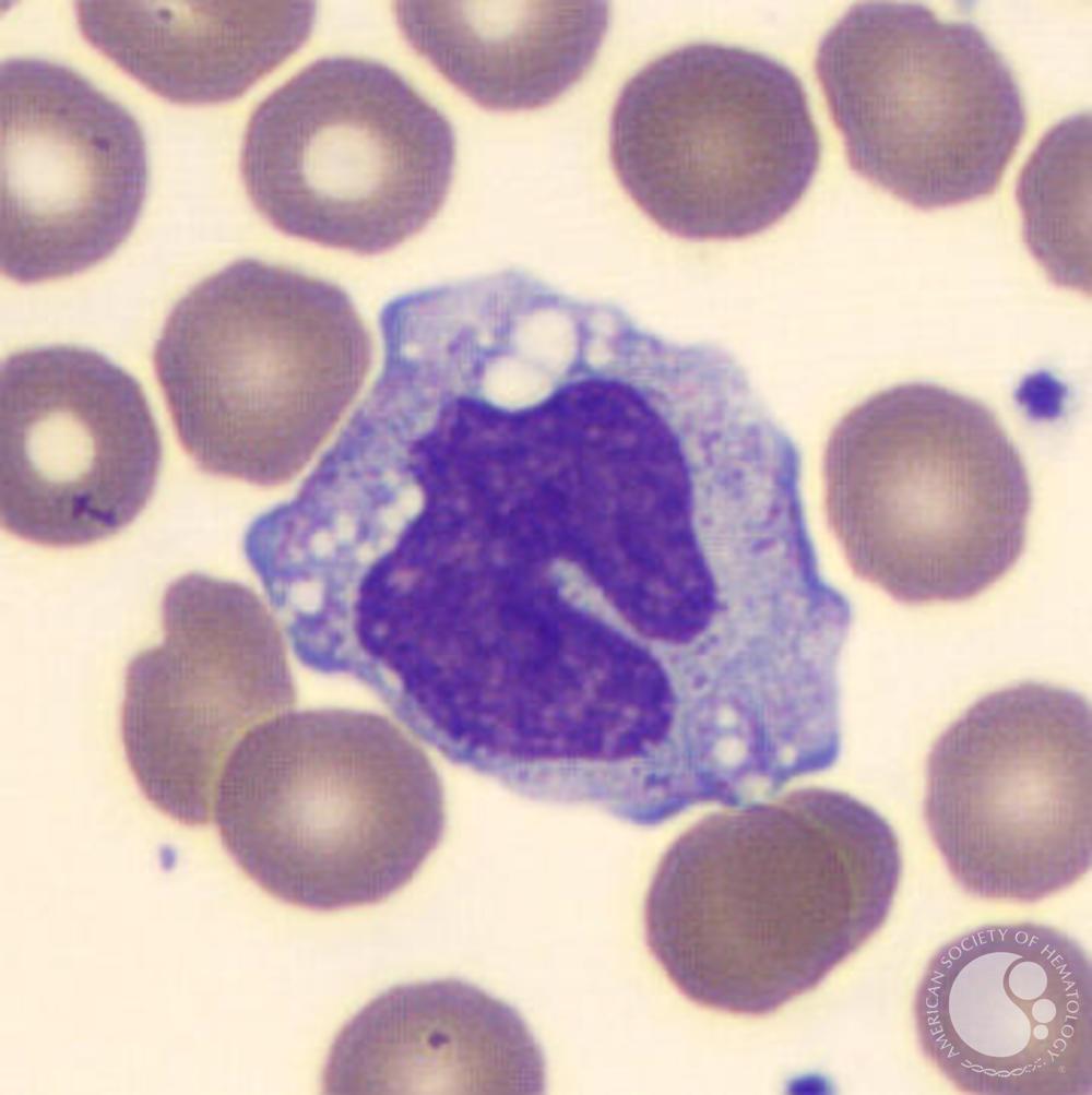 <ul><li><p>size: 12-20 um</p></li><li><p>N:C ratio is 1:1</p></li><li><p>nucleus is loosely woven and thin, and the cytoplasm is light purple/blue or pinkish</p></li><li><p>CD33, CD13, CD14 (14 is specific to monocytes)</p></li></ul><p></p>
