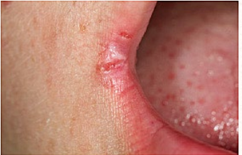 <p>acute or chronic inflammation located at the lateral commissures of the mouth</p>