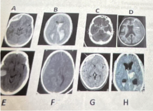 <p><strong>What is photo D? </strong></p><p>a. intracerebral hemorrhage</p><p>b. subdural hemorrhage</p><p>c. intracerebral/ subarachnoid hemorrhage</p><p>d. epidural hemorrhage</p>