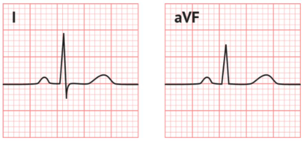 <p>What is the axis of the following ECG?</p>
