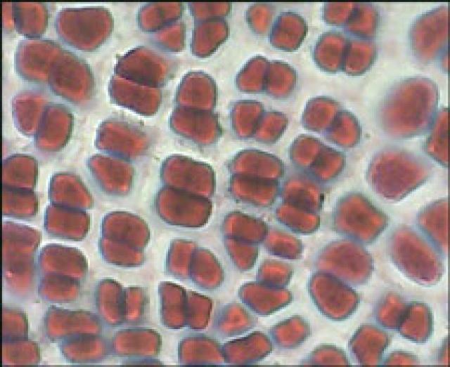 <p>Blood clots </p>