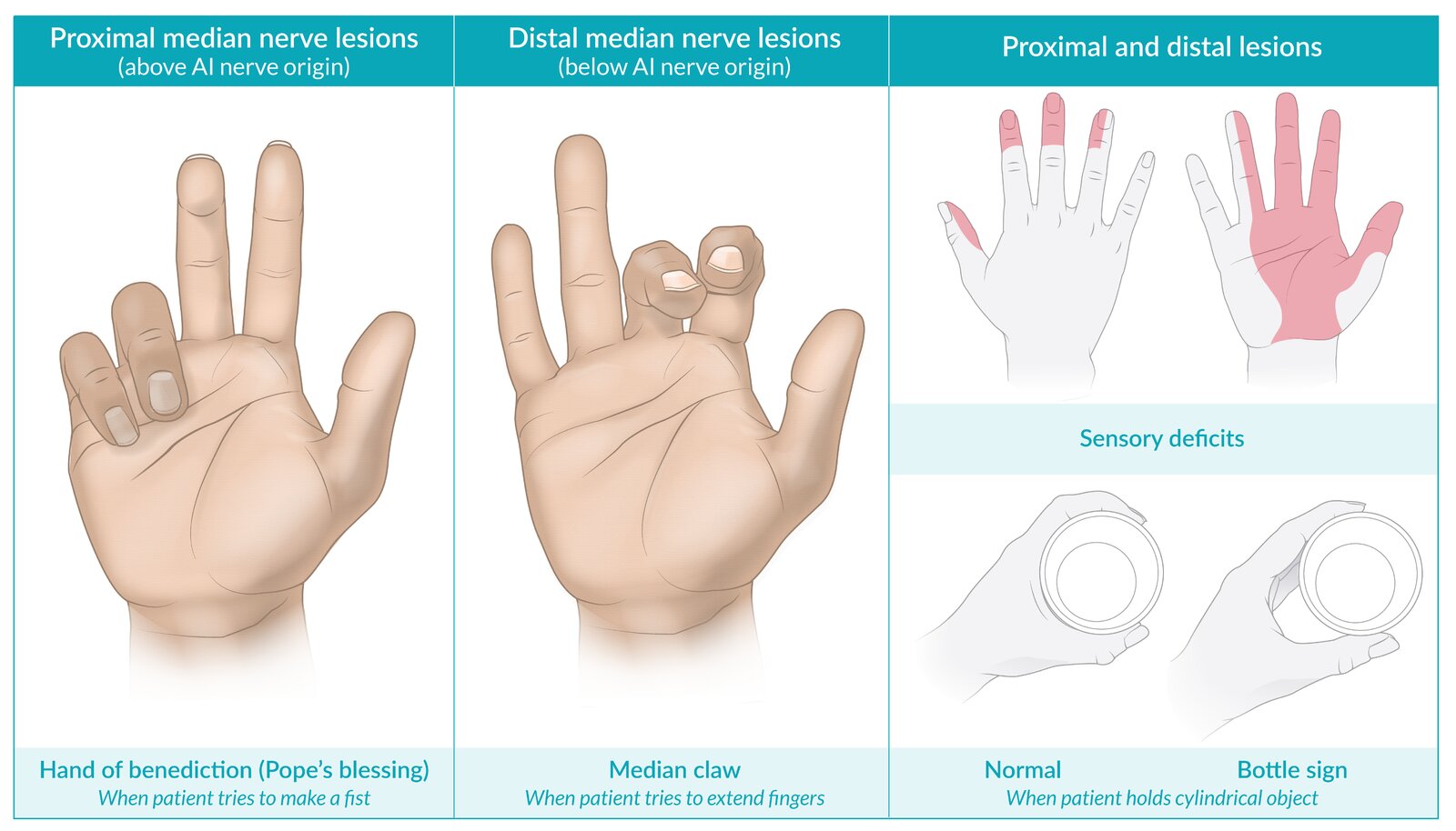 <p>-See sensory loss for median distribution</p><p>-Motor loss</p><ul><li><p>Lose thumb opposition, flexion, abduction</p></li><li><p>Lose lumbrical movement for index and middle fingers</p></li><li><p>High lesions (at/above elbow) can also lose flexion of tip of index/middle fingers/thumb, ability to flex radial aspect of wrist </p></li></ul><p>-Dorsal protection splint with wrist at 30 flexion (+ extend to elbow at 90 flexion for high lesions) to help median nerve heal after repair</p><ul><li><p>begin ROM with wrist flexed while wearing orthosis at 5-7 days s/p sx</p></li></ul><p>-AROM out of orthosis once cleared (~4wks)</p><p>-Later orthoses may need c bar to prevent thumb adduction contracture; opponens orthosis can improve function</p><p>-Sensory reeducation</p>