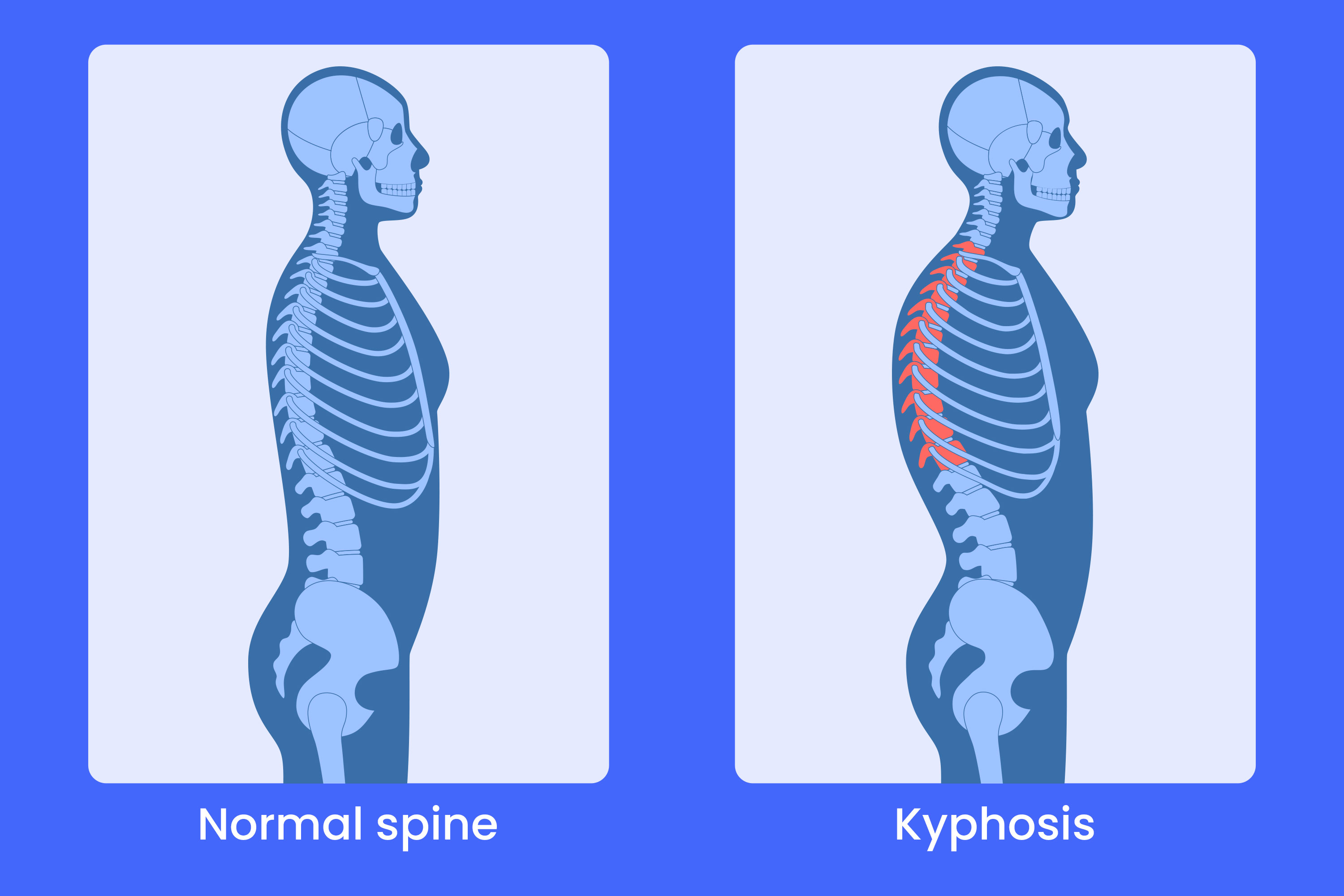 <ul><li><p>Growth retardation or improper development of the epiphyses as a result of rapid growth</p></li><li><p>No symptoms may occur, may be mild pain, tiredness, or tenderness or stiffness of the thoracic spine</p></li><li><p>Common Treatments: </p><ul><li><p>Exercise, </p></li><li><p>a firm mattress</p></li><li><p> back brace</p></li></ul></li></ul><p></p>