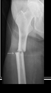 <p>Transverse fracture</p>
