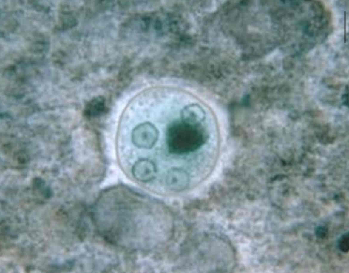 <p>Agente patologico che causa dissenteria amebica</p><p>Lo stadio infettivo è la cisti tetranucleata, che una volta raggiunto l’intestino tenue si apre e rilascia 4 <u>trofozoiti</u></p><p>Questi producono enzimi idrolitici che digeriscono le cellule della mucosa intestinale causando ulcere.</p><p>Una volta entrati in circolo possono nutrirsi di ertitrociti e invadere altri organi, tra cui fegato e polmoni</p><p>I trofozoiti che passano si incistano e le cisti vengono rilasciati all’esterno con le feci.</p><p>Le cisti rimangono vitali anche per alcune settimane</p>