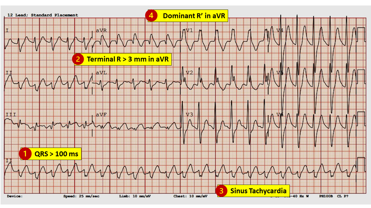 <p>Tricyclic Overdose ECG</p>