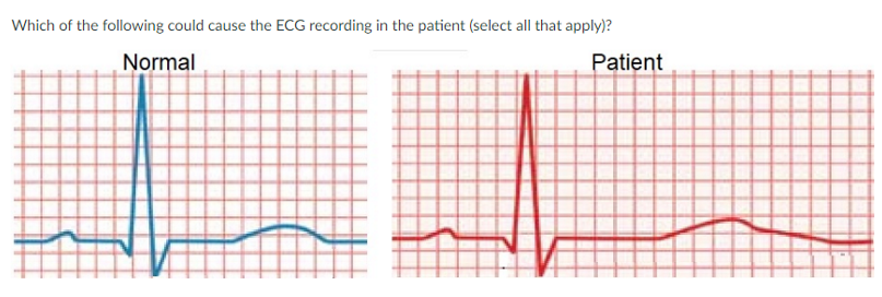 <p>JONES IN CLASS ASSIGNMENT QUESTIONS:</p><p>SATA:</p><p>a. pharmalogical administration of a K+ channel blocker</p><p>b. hyperkalemia</p><p>c. ectopic ventricular foci firing</p><p>d. hypocalcemia </p><p>e. reactivation of ventricular muscle Na+ channels</p>