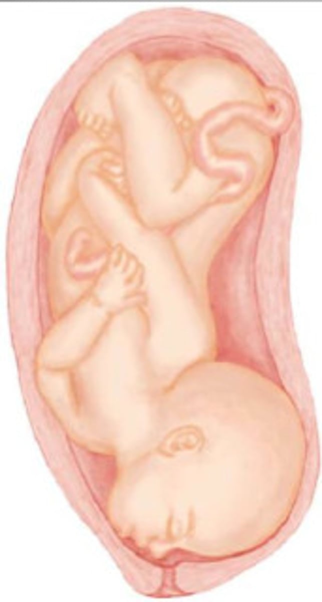 <p>-abnormal</p><p>-head is extended away from the fetal chest</p>