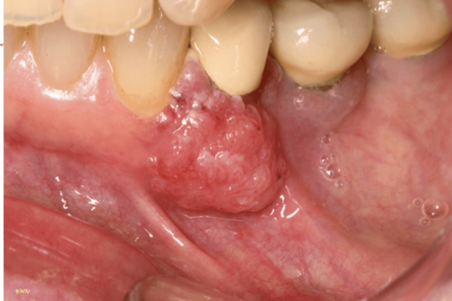 <p>Hint: mimics common, benign inflammatory and reactive lesions (pyogenic granuloma)</p>