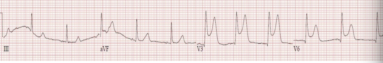 <p>ECG shows ST elevation</p>