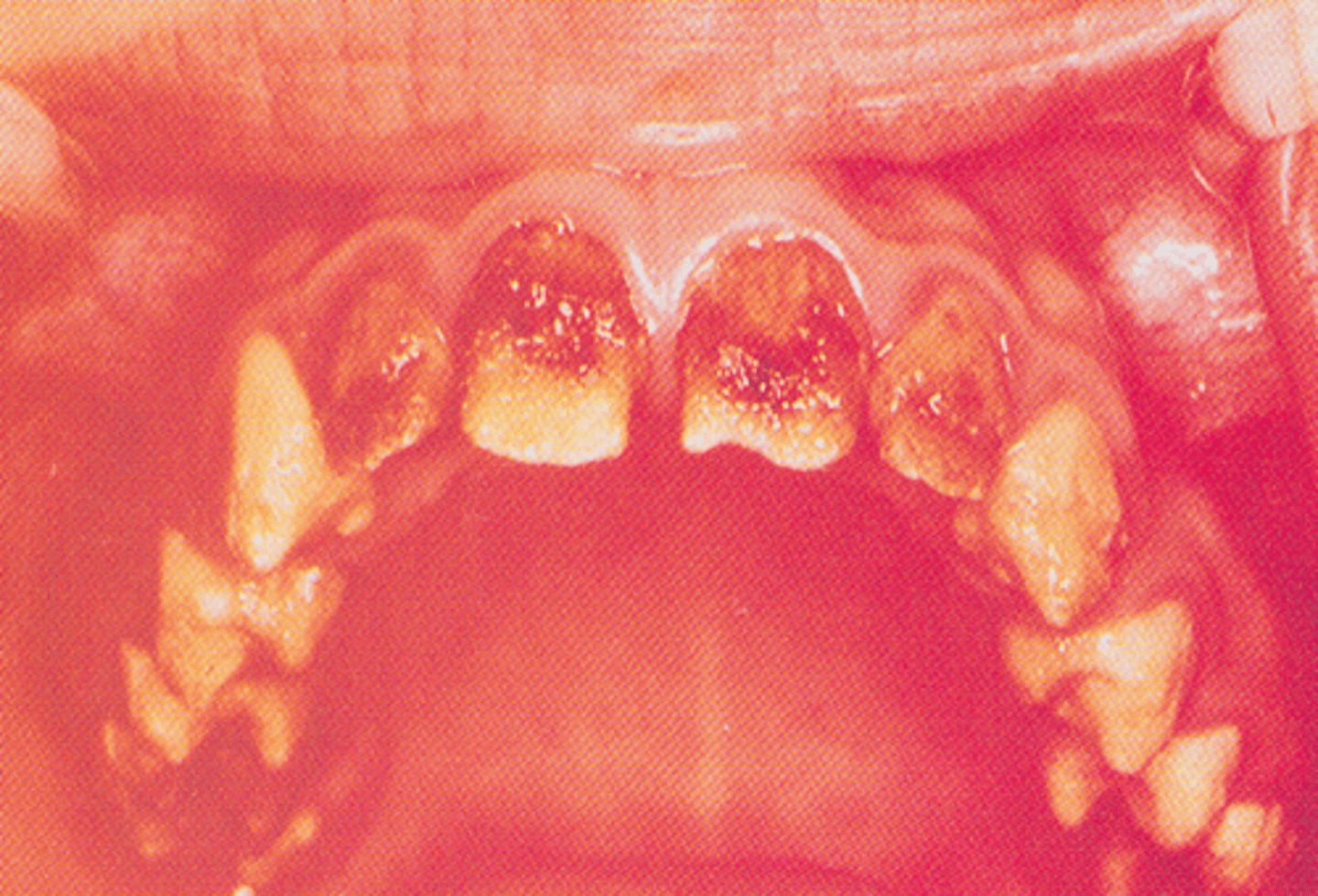 <p>-loss of enamel is exhibited in the teeth</p><p>-enamel of normal thickness that is poorly calcified</p><p>-yellow to orange enamel</p>