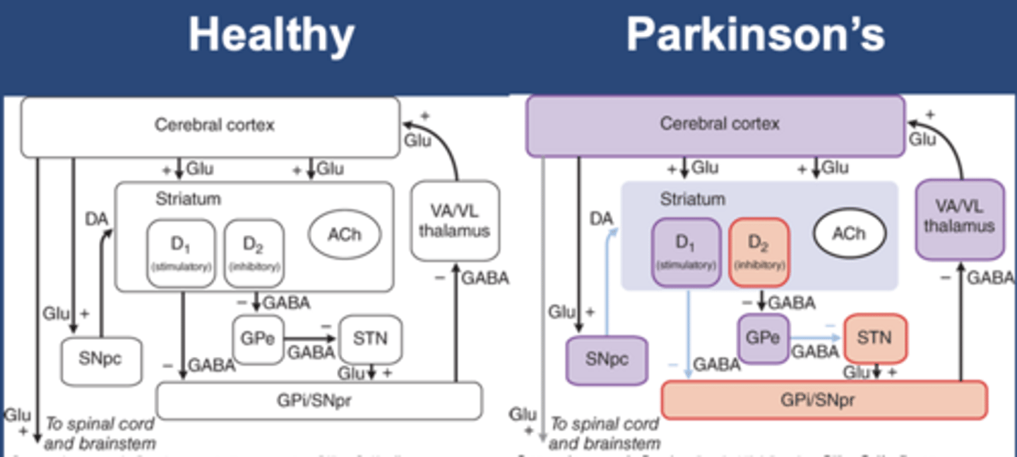 <p>-Slow movement</p><p>-Purple: loss of activity</p><p>-Red: gain of activity</p><p>-Decrease in DA decreases stimulatory D1 and inhibitory D2</p><p>-Results in decreased cerebral/motor cortex stimulation</p><p>-Less cerebral/motor cortex activity leads to bradykinesia in PD</p>