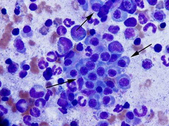 <p><span>2+ criteria met:</span><br><span>1. monoclonal gammopathy</span><br><span>2. visceral plasma cell proliferation</span><br><span>3. bence jones proteinuria</span><br><span>4. bone marrow plasmacytosis (less common than in dogs)- suggested that 10% infiltration consistent with MM</span></p>