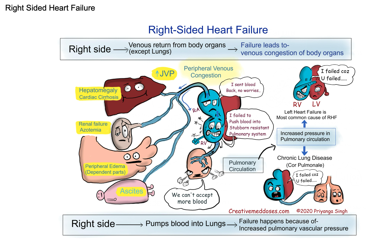 <ul><li><p>Fluid backed up into peripheral circulation</p><ul><li><p>Is it leaving body? Why not?</p></li></ul></li><li><p>Systolic dysfunction: cardiomyopathy, myocardits, weak heart muscle due to MI, ischemia, heart disease, pulmonary embolism, chronic pulmonary disease, hypervolemia, tricuspid stenosis (all increase RA ESV and pressure)</p></li><li><p>Diastolic dysfunction: cardiomyopathy with right ventricular hypertrophy, cardiac tamponade or pericarditis</p></li><li><p>In this case blood backs up into the peripheral circulation (organ distention - hempatomegaly, splenomegaly, peripheral edema, JVD)</p></li><li><p>#1 cause of RHF = LHF and pulmonary HTN</p></li><li><p><strong>Cor pulmonale</strong> = chronic pulmonary HTN (due to lung disease - left side if fine, caused by lungs) that causes RHF/enlargment “pulmonary heart”</p></li></ul><p></p>